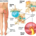 Sciatica pain