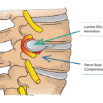Disc herniation in lower back treated with advanced spine care by Dr. Ashish Upadhyay in Bristol, CT.