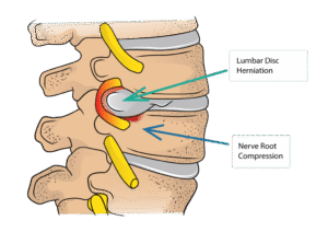 Disc herniation in lower back treated with advanced spine care by Dr. Ashish Upadhyay in Bristol, CT.