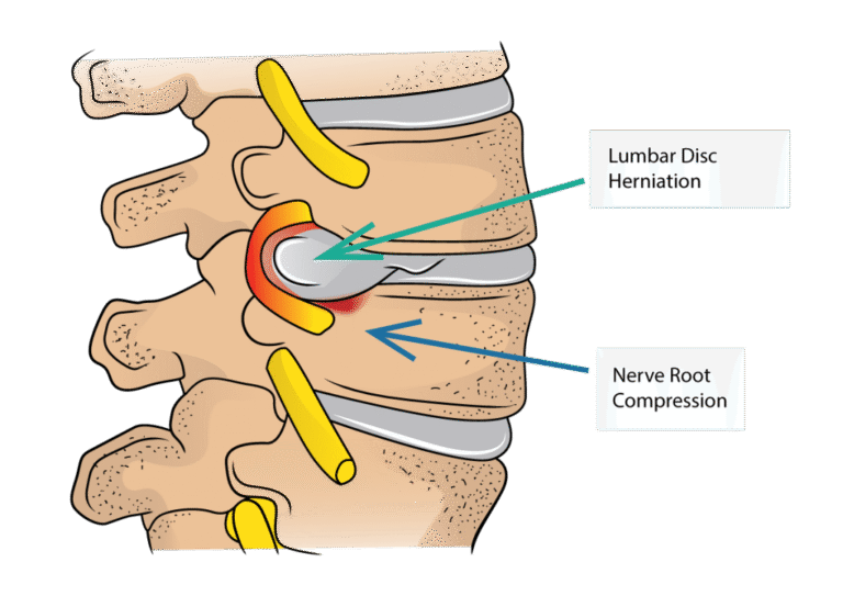 Herniation Rosh Disc Herniation in Lower back: Symptoms, Surgery & Relief ...