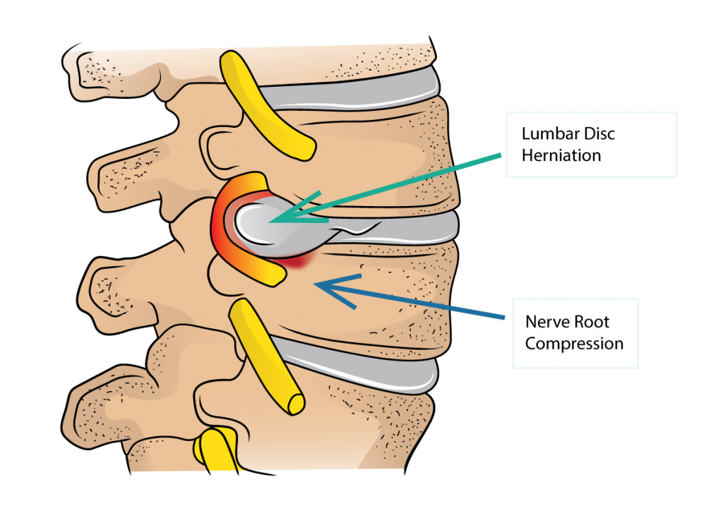 Disc herniation in lower back treated with advanced spine care by Dr. Ashish Upadhyay in Bristol, CT.
