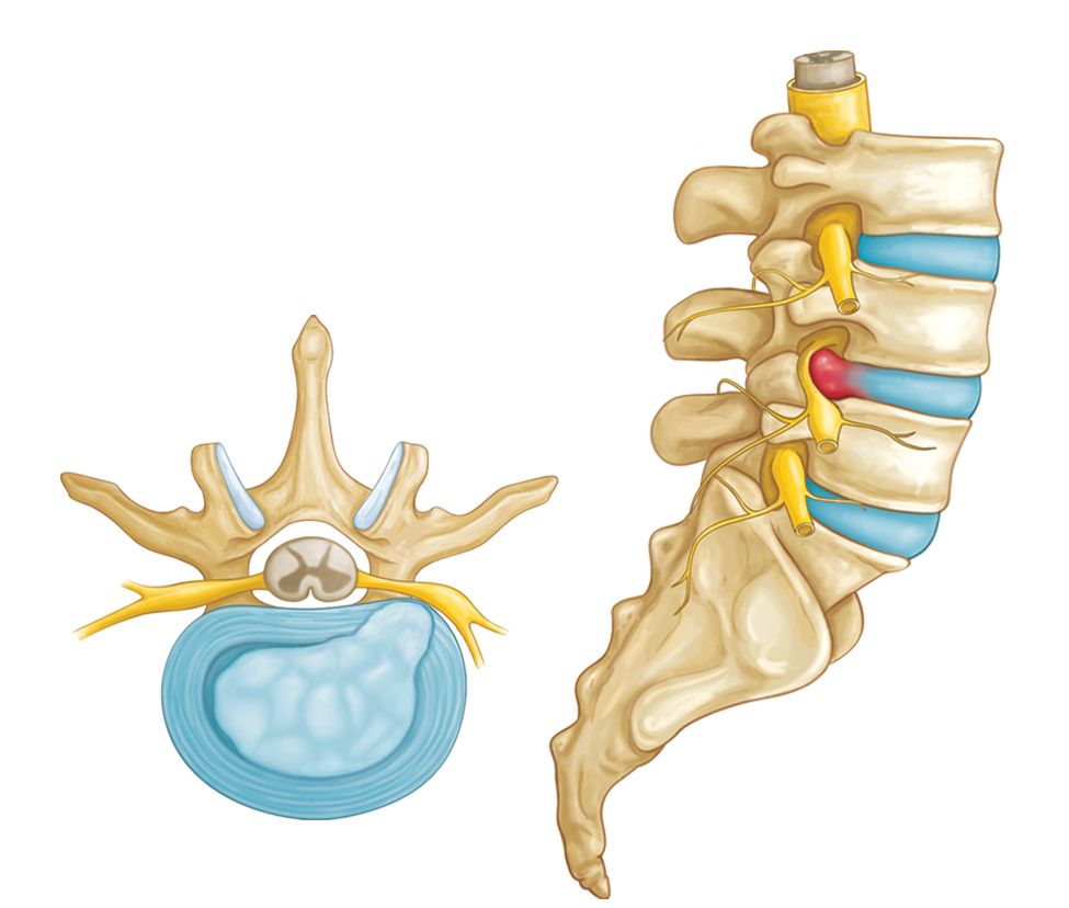 Disc Herniation in Lower Back: Symptoms, Surgery & Relief
