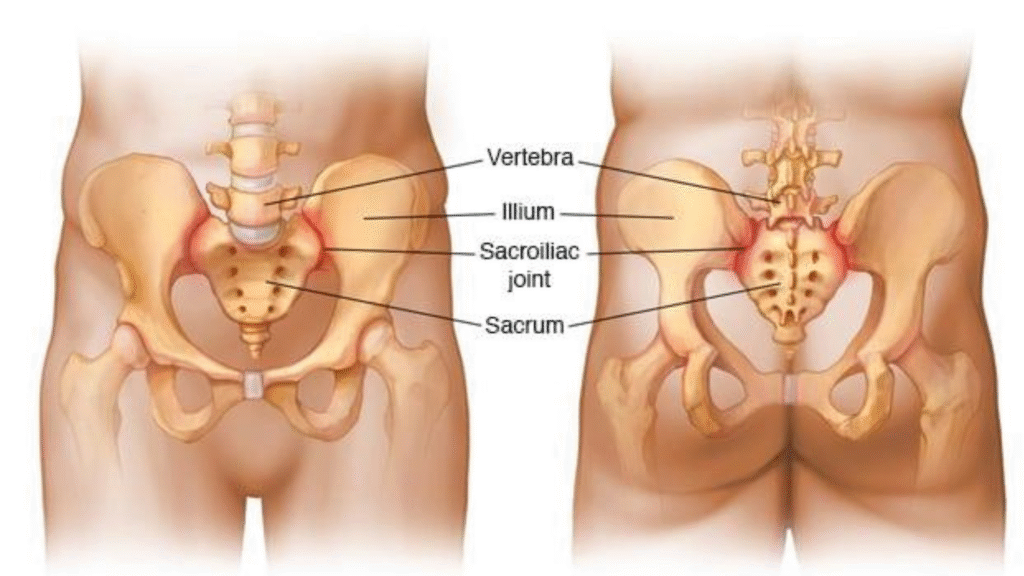spinal stenosis and sacroiliac joint pain
